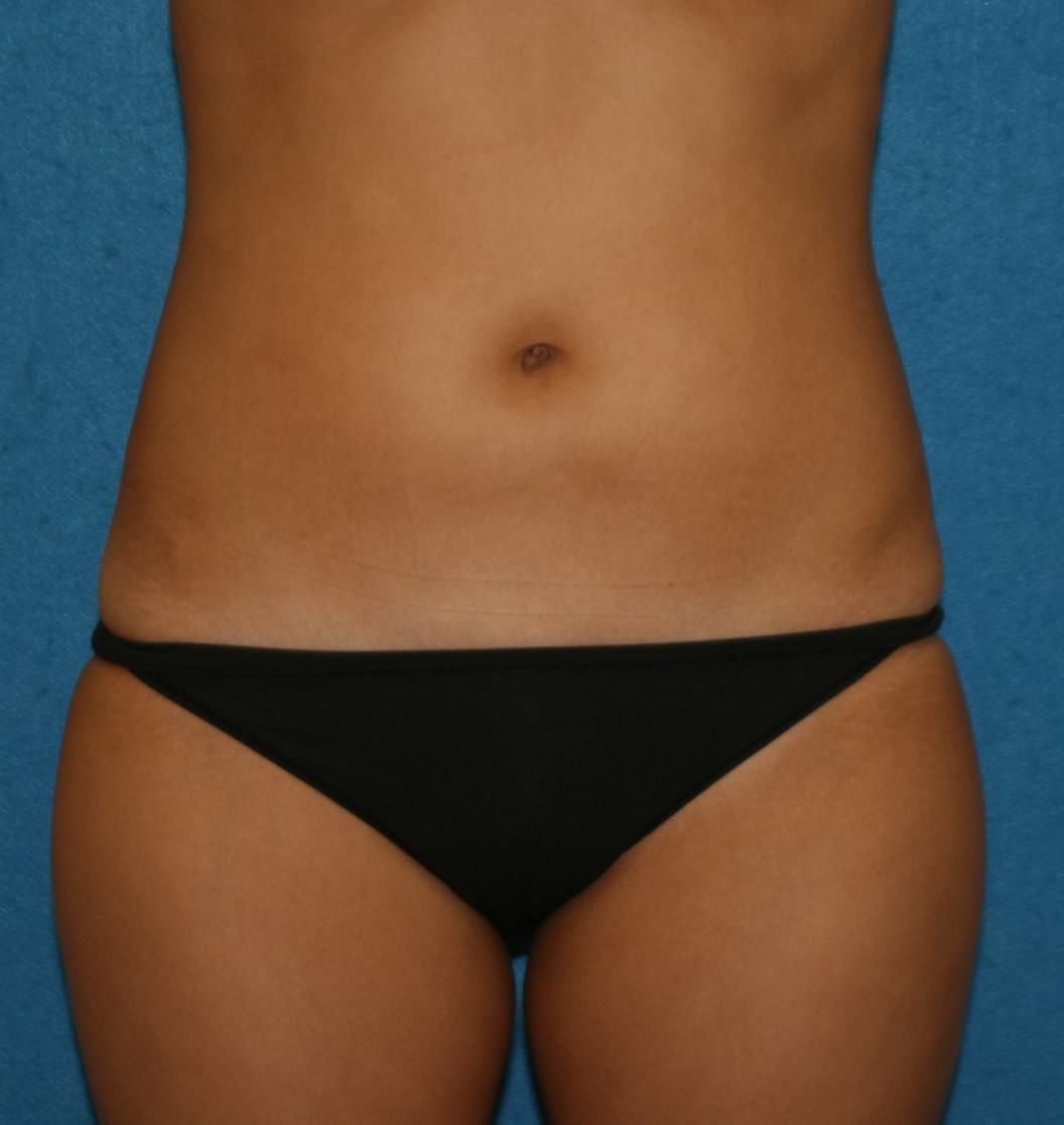 Abdominoplasty and Liposuction Thighs and Flanks Case 92109 - The Plastic  Surgery Group